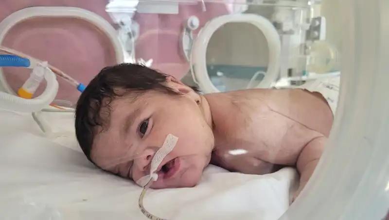 34 Haftalık Eymen Bebek Dünyada 7. Vaka Olarak Yaşam Mücadelesi Veriyor